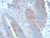 IHC staining of FFPE human colon carcinoma with Calpain antibody (clone CAPN1/1530). HIER: boil tissue sections in pH 9 10mM Tris with 1mM EDTA for 20 min and allow to cool before testing.