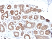IHC staining of FFPE human breast carcinoma with Calpain antibody (clone CAPN1/1530). HIER: boil tissue sections in pH 9 10mM Tris with 1mM EDTA for 20 min and allow to cool before testing.