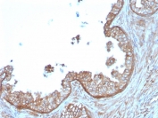 IHC staining of FFPE human prostate carcinoma with Calpastatin antibody (clone CAST/1550). HIER: boil tissue sections in pH 9 10mM Tris with 1mM EDTA for 20 min and allow to cool before testing.