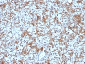 IHC staining of FFPE human bladder carcinoma with Calpastatin antibody (clone CAST/1550). HIER: boil tissue sections in pH 9 10mM Tris with 1mM EDTA for 20 min and allow to cool before testing.