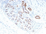 IHC staining of FFPE human breast carcinoma with p40 antibody. HIER: boil tissue sections in pH 9 10mM Tris with 1mM EDTA for 20 min and allow to cool before testing.