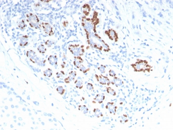 IHC staining of FFPE human breast carcinoma with p40 antibody. HIER: boil tissu