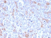 IHC staining of FFPE human pancreatic carcinoma with MRP3 antibody (clone ABCC3/2971). HIER: boil tissue sections in pH 9 10mM Tris with 1mM EDTA for 20 min and allow to cool before testing.