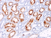 IHC staining of FFPE human renal cell carcinoma with CD137L antibody (clone CD137L/1547). HIER: boil tissue sections in pH 9 10mM Tris with 1mM EDTA for 10-20 min and allow to cool before testing.