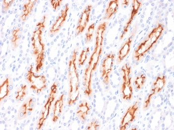 IHC staining of FFPE human renal cell carcinoma with CD137L antibody. HIER: boil tissue sections in pH 9 10mM Tris with 1mM EDTA for 10-20 min and allow to cool before testing.