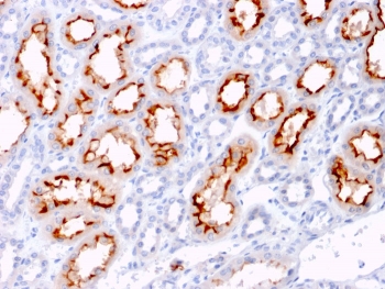 IHC staining of FFPE human renal cell carcinoma with CD137L antibody. HIER: boil tissue sections in pH 9 10mM Tris with 1mM EDTA for 10-20 min and allow to cool before testing.