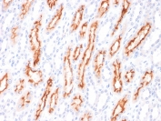 IHC staining of FFPE human renal cell carcinoma with CD137L antibody (clone CD137L/1547). HIER: boil tissue sections in pH 9 10mM Tris with 1mM EDTA for 10-20 min and allow to cool before testing.