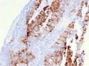 IHC staining of FFPE human colon carcinoma with DR5 antibody (clone DR5/3381). HIER: boil tissue sections in pH 9 10mM Tris with 1mM EDTA for 20 min and allow to cool before testing.