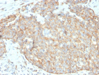 IHC staining of FFPE human breast carcinoma with DR5 antibody. HIER: boil tissue sections in pH 9 10mM Tris with 1mM EDTA for 20 min and allow to cool before testing.
