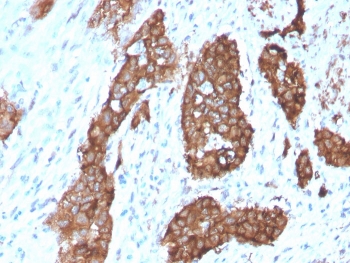 IHC staining of FFPE human breast carcinoma with PDLIM1 antibody (clone CPTC-PDLIM1-1). HIER: boil tissue sections in pH 9 10mM Tris with 1mM EDTA for 20 min and allow to cool before testing.~