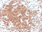 IHC staining of FFPE human tonsil with recombinant CD3e antibody (clone rC3e/1308). HIER: boil tissue sections in pH 9 10mM Tris with 1mM EDTA for 10-20 min and allow to cool before testing.
