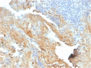 IHC staining of FFPE human lung with Fibronectin antibody (clone FN1/2950). HIER: boil tissue sections in pH 9 10mM Tris with 1mM EDTA for 20 min and allow to cool before testing.