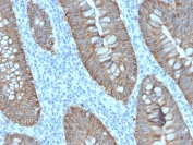 IHC staining of FFPE human colon carcinoma with recombinant EpCAM antibody (clone EGP40/2571R). HIER: boil tissue sections in pH 9 10mM Tris with 1mM EDTA for 10-20 min and allow to cool before testing.