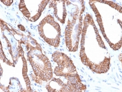 IHC staining of FFPE human prostate carcinoma with recombinant EpCAM antibody (clone EGP40/2571R). HIER: boil tissue sections in pH 9 10mM Tris with 1mM EDTA for 10-20 min and allow to cool before testing.