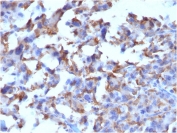 IHC testing of FFPE human histiocytoma with CD163 antibody (clone M130/2162). HIER: boil tissue sections in pH 9 10mM Tris with 1mM EDTA for 10-20 min followed by cooling at RT for 20 min.
