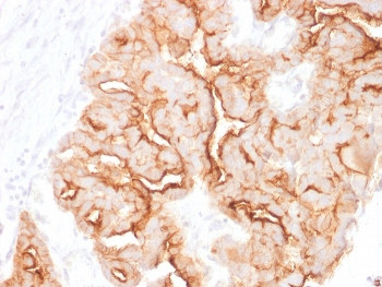IHC staining of FFPE human ovarian carcinoma with MUC16 antibody. HIER: boil tissue sections in pH 9 10mM Tris with 1mM EDTA for 20 min and allow to cool before testing.~
