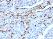 IHC staining of FFPE human lung adenocarcinoma with Napsin A antibody (clone NAPSA/3309). HIER: boil sections in pH 9 10mM Tris with 1mM EDTA for 10-20 minutes, followed by cooling at RT for 20 minutes, prior to staining.