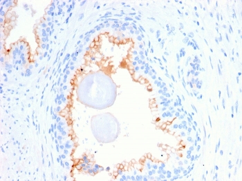 IHC staining of FFPE human prostate carcinoma with CD10 antibody (clone MME/2580). HIER: boil tissue sections in pH 9 10mM Tris with 1mM EDTA for 20 min and allow to cool before testing.