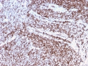 IHC staining of FFPE human cervix tissue with recombinant CD44 antibody (clone rHCAM/918). HIER: boil tissue sections in pH 9 10mM Tris with 1mM EDTA for 20 min and allow to cool before testing.