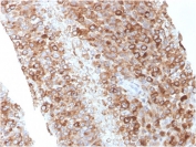 IHC staining of FFPE human melanoma with CD63 antibody (clone LAMP3/2881). HIER: boil tissue sections in pH 9 10mM Tris with 1mM EDTA for 20 min and allow to cool before testing.