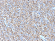 IHC staining of FFPE human melanoma with CD63 antibody (clone LAMP3/2790). HIER: boil tissue sections in pH 9 10mM Tris with 1mM EDTA for 20 min and allow to cool before testing.