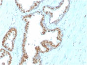 IHC staining of FFPE human prostate carcinoma with  NKX3.1 antibody (clone NKX3.1/3347). HIER: boil tissue sections in pH 9 10mM Tris with 1mM EDTA for 20 min and allow to cool before testing.