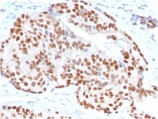 IHC staining of FFPE human prostate carcinoma with  NKX3.1 antibody (clone NKX3.1/3347). HIER: boil tissue sections in pH 9 10mM Tris with 1mM EDTA for 20 min and allow to cool before testing.