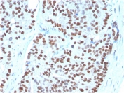 IHC staining of FFPE human prostate carcinoma with  NKX3.1 antibody (clone NKX3.1/3348). HIER: boil tissue sections in pH 9 10mM Tris with 1mM EDTA for 20 min and allow to cool before testing.