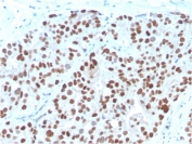 IHC staining of FFPE human prostate carcinoma with  NKX3.1 antibody (clone NKX3.1/3348). HIER: boil tissue sections in pH 9 10mM Tris with 1mM EDTA for 20 min and allow to cool before testing.