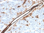 IHC staining of FFPE human tumor with CD31 antibody (clone PECAM1/3526). HIER: boil tissue sections in pH 9 10mM Tris with 1mM EDTA for 10-20 min and allow to cool before testing.