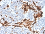 IHC staining of FFPE human tumor with CD31 antibody (clone PECAM1/3526). HIER: boil tissue sections in pH 9 10mM Tris with 1mM EDTA for 10-20 min and allow to cool before testing.