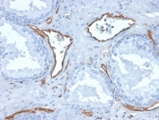 IHC staining of FFPE human prostate with CD31 antibody (clone PECAM1/3527). HIER: boil tissue sections in pH 9 10mM Tris with 1mM EDTA for 10-20 min and allow to cool before testing.