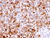 IHC staining of FFPE human melanoma with CD63 antibody (clone LAMP3/2788). HIER: boil tissue sections in pH 9 10mM Tris with 1mM EDTA for 20 min and allow to cool before testing.