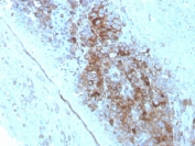 IHC staining of FFPE human melanoma with CD63 antibody (clone LAMP3/2789). HIER: boil tissue sections in pH 9 10mM Tris with 1mM EDTA for 20 min and allow to cool before testing.