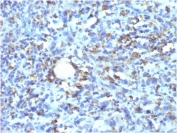 IHC staining of FFPE human histiocytoma with recombinant CD68 antibody (clone rLAMP4/824). HIER: boil tissue sections in pH 9 10mM Tris with 1mM EDTA for 10-20 min followed by cooling at RT for 20 min.