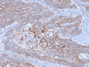 IHC staining of FFPE human breast carcinoma with E-Cadherin antibody (clone CDH1/3256). HIER: boil tissue sections in pH 9 10mM Tris with 1mM EDTA for 20 min and allow to cool before testing.