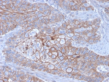 IHC staining of FFPE human breast carcinoma with E-Cadherin antibody (clone CDH1/3256). HIER: boil tissue sections in pH 9 10mM Tris with 1mM EDTA for 20 min and allow to cool before testing.