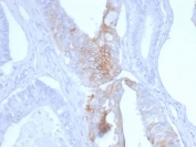 IHC staining of FFPE human colon carcinoma with Cytokeratin 20 antibody (clone KRT20/3145). HIER: boil tissue sections in pH 9 10mM Tris with 1mM EDTA for 20 min and allow to cool before testing.