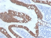 IHC staining of FFPE human colon carcinoma with Cytokeratin 20 antibody (clone KRT20/3145). HIER: boil tissue sections in pH 9 10mM Tris with 1mM EDTA for 20 min and allow to cool before testing.