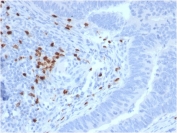 IHC staining of FFPE human colon carcinoma with c-RET antibody (clone RET/2795). HIER: boil tissue sections in pH 9 10mM Tris with 1mM EDTA for 20 min and allow to cool before testing.