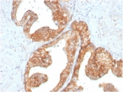 IHC staining of FFPE human prostate carcinoma with c-RET antibody (clone RET/2795). HIER: boil tissue sections in pH 9 10mM Tris with 1mM EDTA for 20 min and allow to cool before testing.