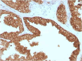 IHC staining of FFPE human prostate carcinoma with c-RET antibody. HIER: boil tissue sections in pH 9 10mM Tris with 1mM EDTA for 20 min and allow to cool before testing.