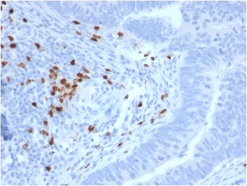 IHC staining of FFPE human colon carcinoma with c-RET antibody. HIER: boil tissue sections in pH 9 10mM Tris with 1mM EDTA for 20 min and allow to cool before testing.