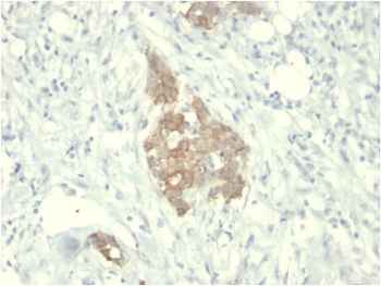IHC staining of FFPE human breast carcinoma with c-RET antibody. HIER: boil tissue sections in pH 9 10mM Tris with 1mM EDTA for 20 min and allow to cool before testing.