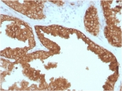 IHC staining of FFPE human prostate carcinoma with c-RET antibody (clone RET/2795). HIER: boil tissue sections in pH 9 10mM Tris with 1mM EDTA for 20 min and allow to cool before testing.