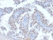 IHC staining of FFPE human prostate carcinoma with RET antibody (clone RET/2663). HIER: boil tissue sections in pH 9 10mM Tris with 1mM EDTA for 20 min and allow to cool before testing.