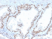 IHC staining of FFPE human prostate carcinoma with RET antibody (clone RET/2663). HIER: boil tissue sections in pH 9 10mM Tris with 1mM EDTA for 20 min and allow to cool before testing.