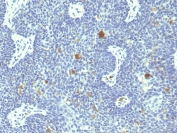 IHC staining of FFPE human cervix with HPV18 E6 antibody (clone HPV18/1297). HIER: boil tissue sections in pH 9 10mM Tris with 1mM EDTA for 20 min and allow to cool before testing.
