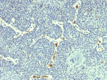 IHC staining of FFPE human cervix with HPV18 E6 antibody (clone HPV18/1297). HIER: boil tissue sections in pH 9 10mM Tris with 1mM EDTA for 20 min and allow to cool before testing.~