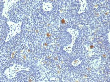 IHC staining of FFPE human cervix with HPV18 E6 antibod